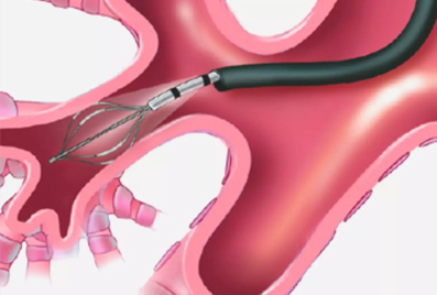 bronchial thermoplasty